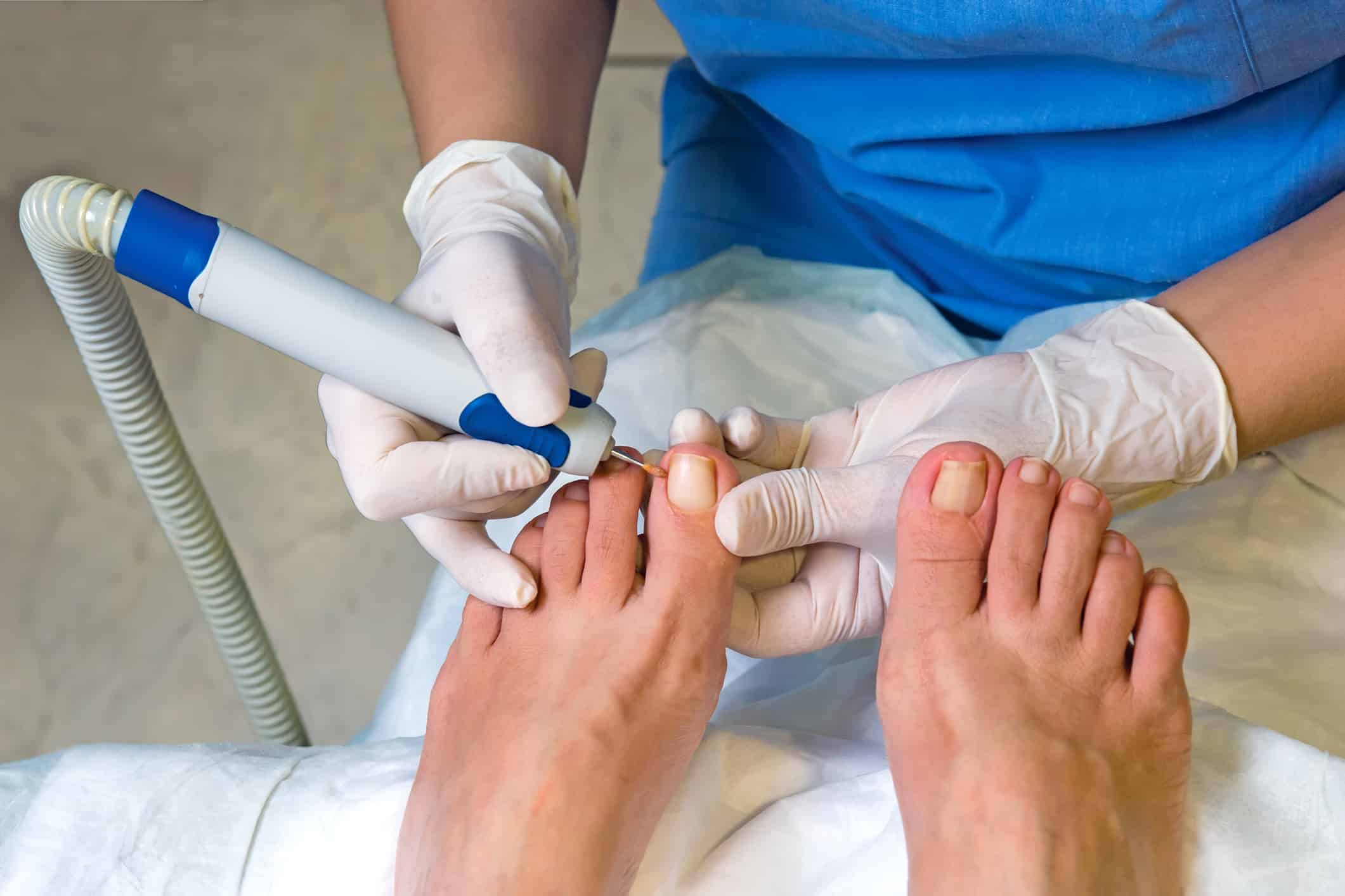 When To Visit A Podiatrist For Your Ingrown Nail Problem