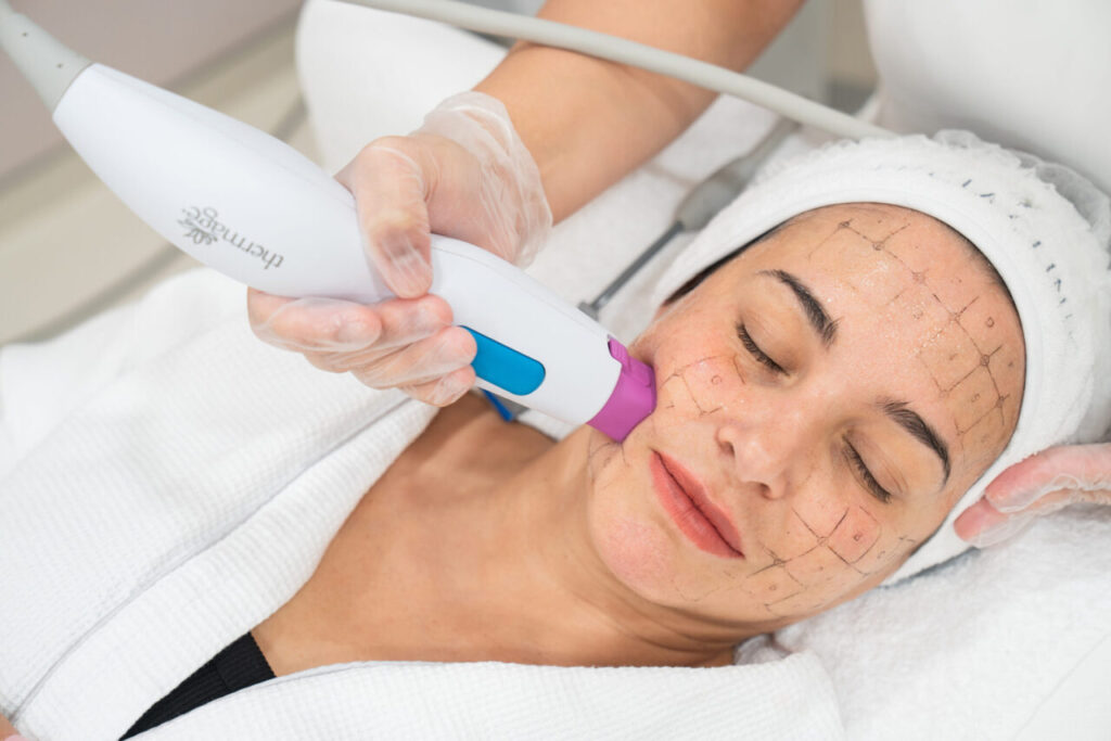 Thermage FLX: The Secret to Tighter, Younger-Looking Skin Without Surgery