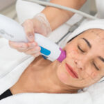 Thermage FLX: The Secret to Tighter, Younger-Looking Skin Without Surgery